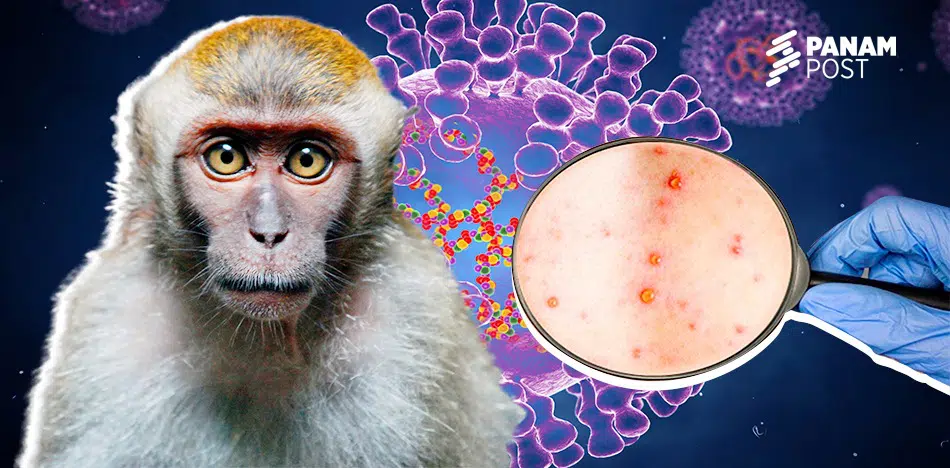 Paranoia en Argentina ante primer caso sospechoso de "viruela del mono"